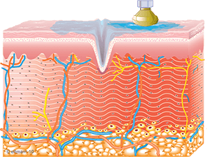 Collagen Synthesis Begins | TempSure